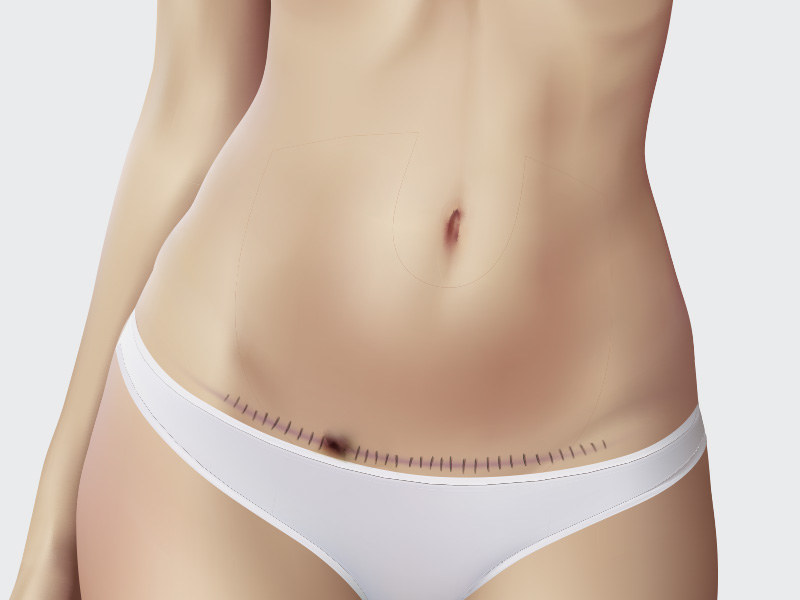 Ponto aberto da abdominoplastia na barriga de uma paciente