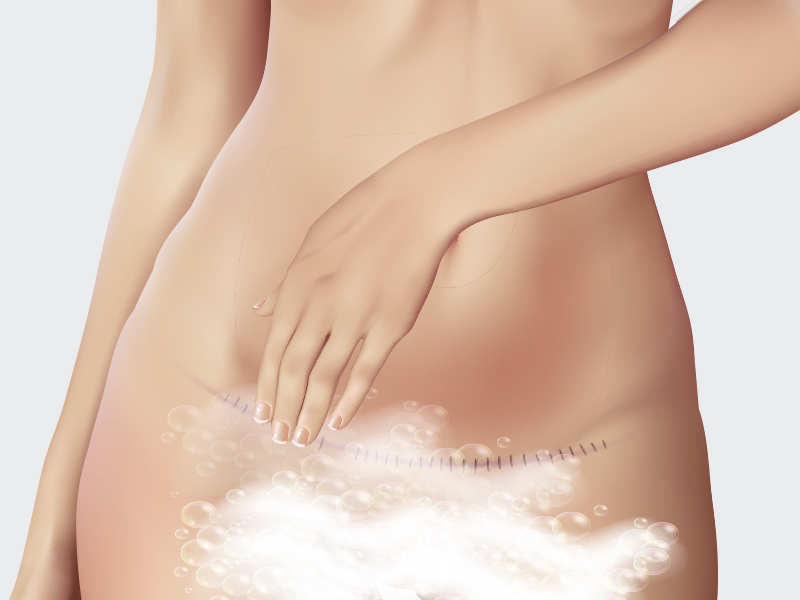 Ilustração de mulher fazendo a limpeza dos pontos inflamados da abdominoplastia com sabão