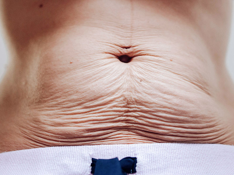 Mulher com a barriga flácida, na dúvida se a Endermoterapia causa flacidez