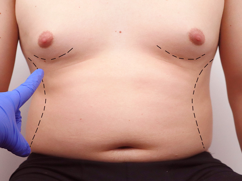 Lipoaspiração abdominal ou abdominoplastia: qual o procedimento mais  adequado para si? - Trofa Saúde