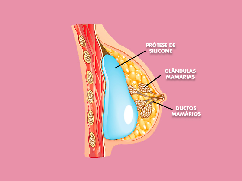 ilustração de onde fica a prótese silicone causa câncer