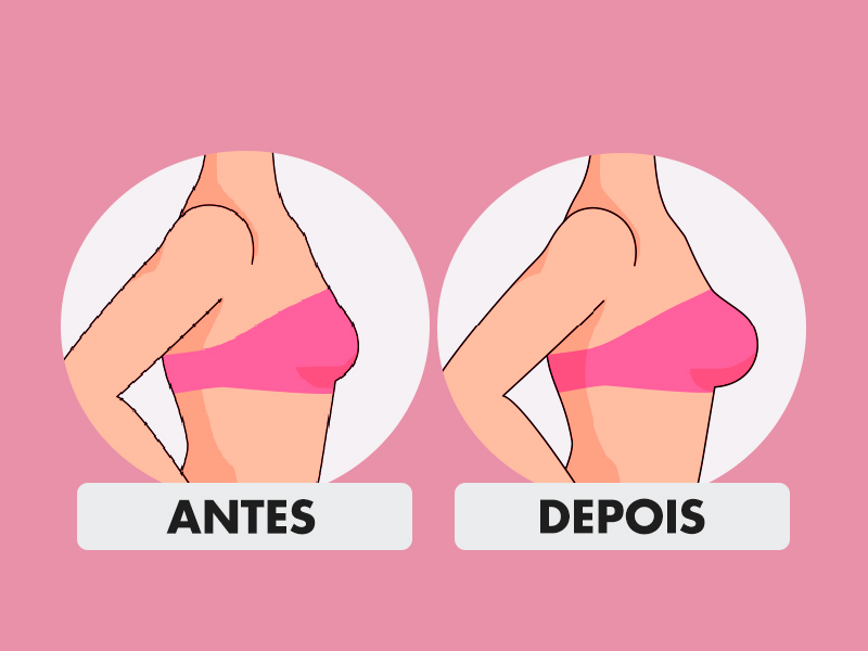 ilustração de silicone antes depois 280ml