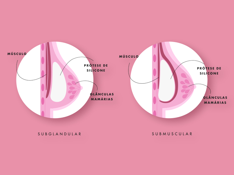 ilustração da prótese silicone câncer mama diagnóstico