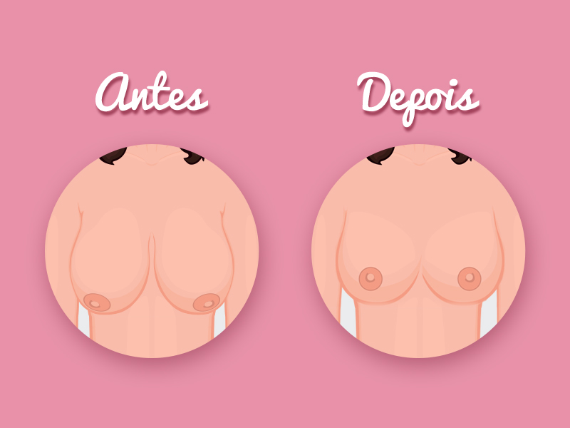 Mastopexia sem Prótese Antes e Depois ideia resultados mastopexia
