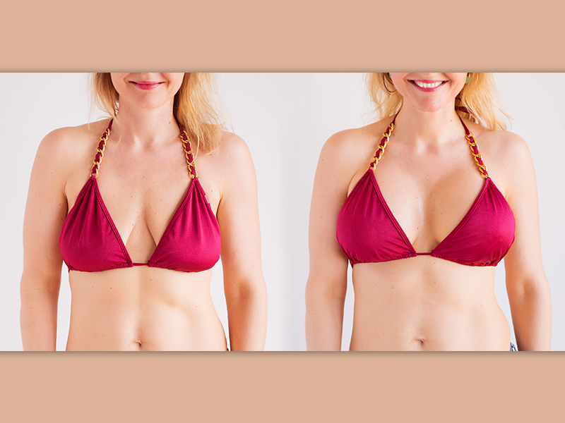 Cirurgia para seios flácidos e murchos Duas fotos, de antes e depois de mulher que fez a cirurgia para tirar flacidez da mama