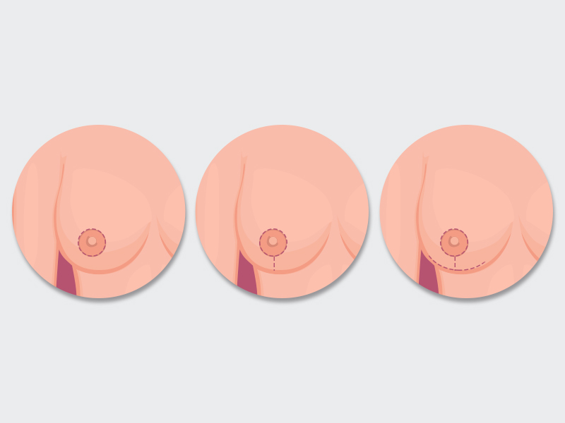 Ilustração que mostra os 3 tipos de Cicatriz da Mamoplastia