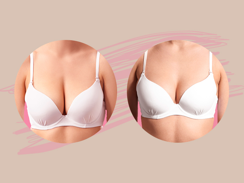 Mamoplastia Antes e Depois Mamoplastia Antes Depois