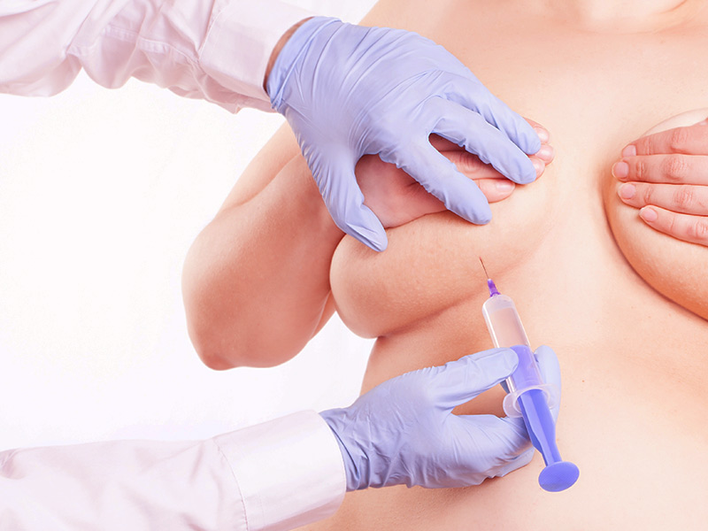 Fazer Mastopexia com enxerto de gordura pode? mastopexia enxerto