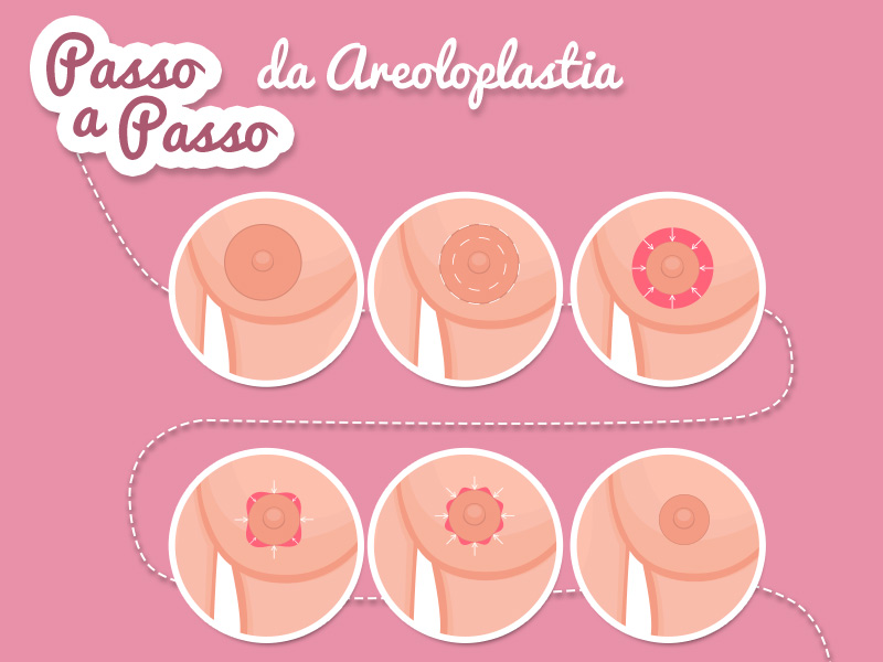 Ilustração com o passo a passo da cirurgia para diminuir aureola grande