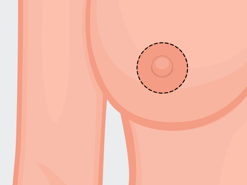 Ilustração da cicatriz de areoloplastia