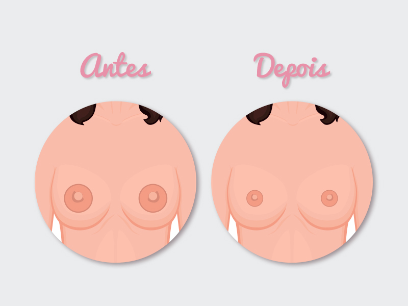 Ilustração da areoloplastia antes e depois