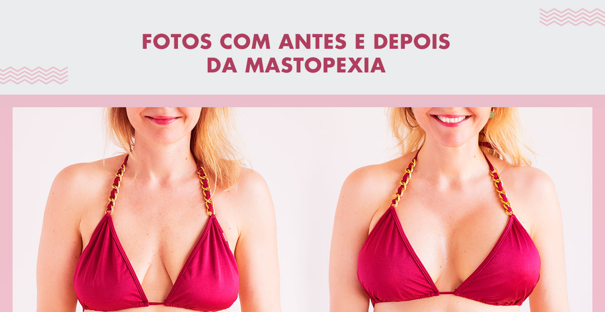 Mastopexia antes e depois – Fotos | Dream Plastic