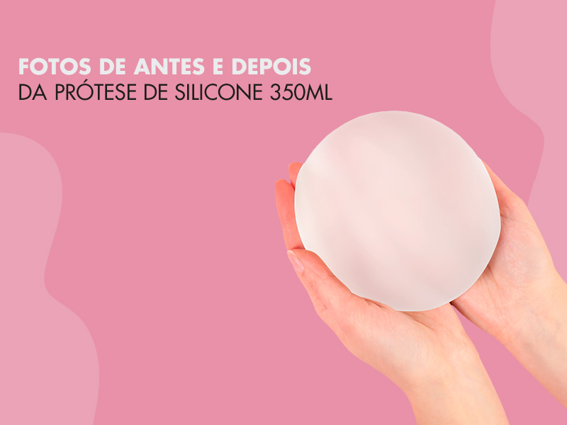 Silicone 350ml Antes e Depois: especialistas revelam o que você precisa fazer para não errar no tamanho da sua prótese! silicone 350ml