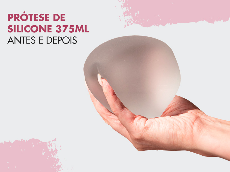 Prótese de silicone 375ml: antes e depois e dicas de especialistas para não se arrepender dessa escolha! silicone 375 ml