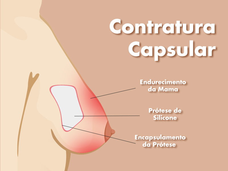 Ilustração mostrando o que é a contratura capsular. 