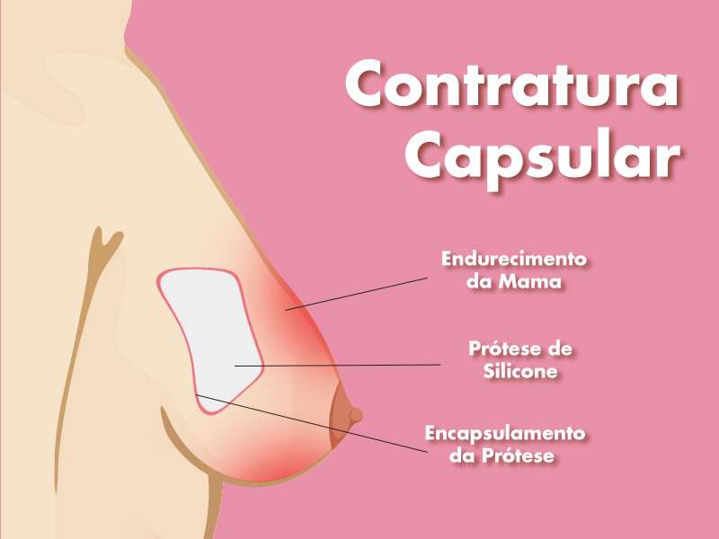 1# O que é rejeição do silicone? que rejeição silicone