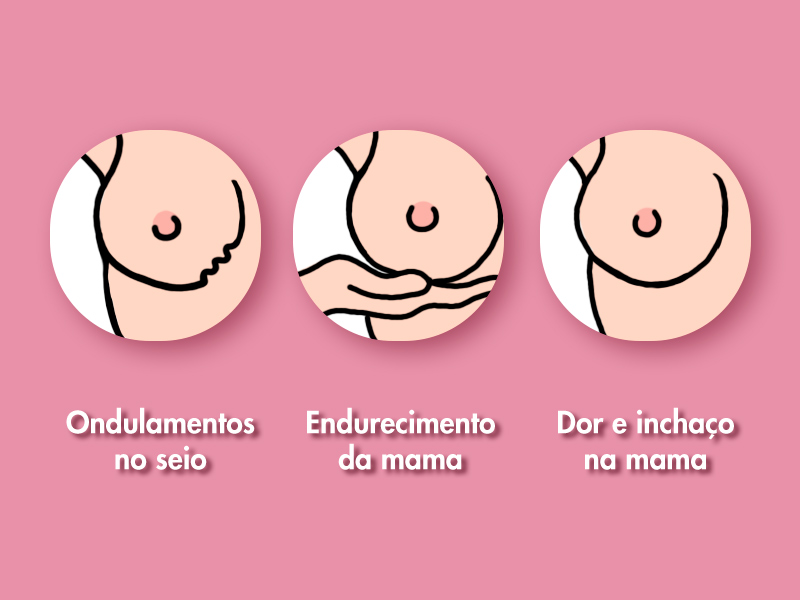 Ilustração com os sintomas da contratura. Lê-se "Ondulamentos no seio", "Endurecimento da mama" e "Dor e inchaço na mama".