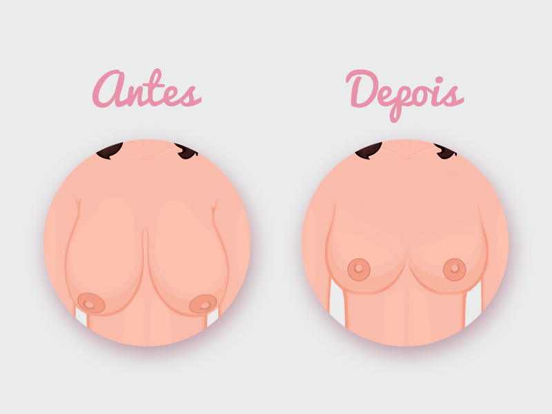 Seios menores no resultado da mamoplastia redutora reducao mama antes depois