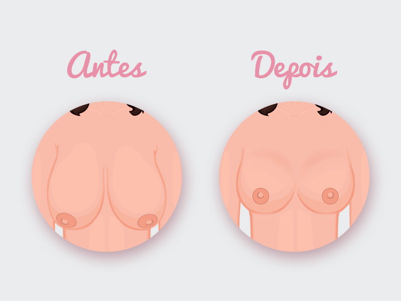 mamoplastia redutora protese antes depois