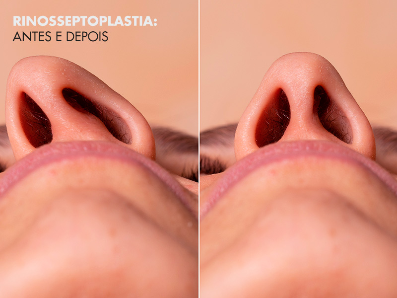 Rinosseptoplastia antes e depois: fotos de famosos e dicas para conquistar o melhor resultado! rinosseptoplastia antes depois