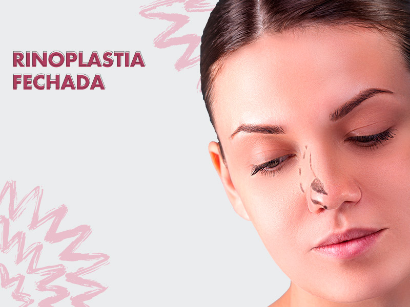 rinoplastia fechada