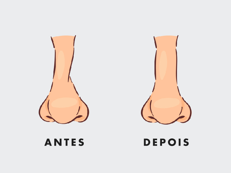 Ilustração do nariz antes e depois da rinosseptoplastia