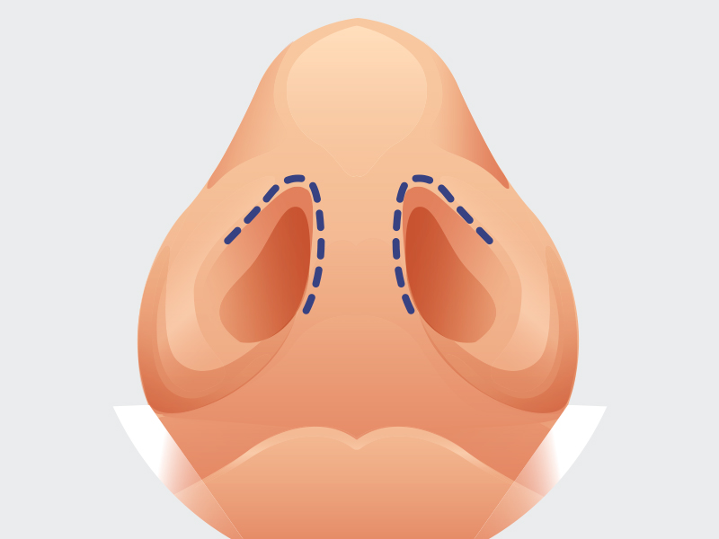 rinoplastia tecnica fechada