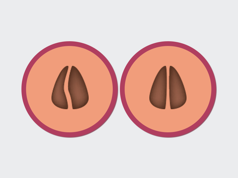 Ilustração que mostra o resultado da septoplastia, um nariz bem mais reto