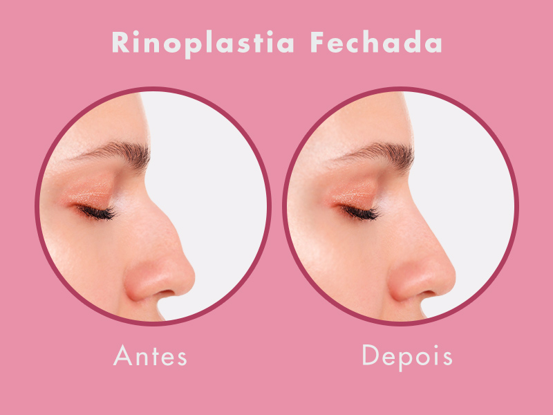 rinoplastia fechada antes depois