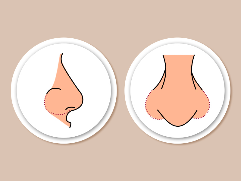 Ilustração mostrando onde fica a cicatriz da alectomia