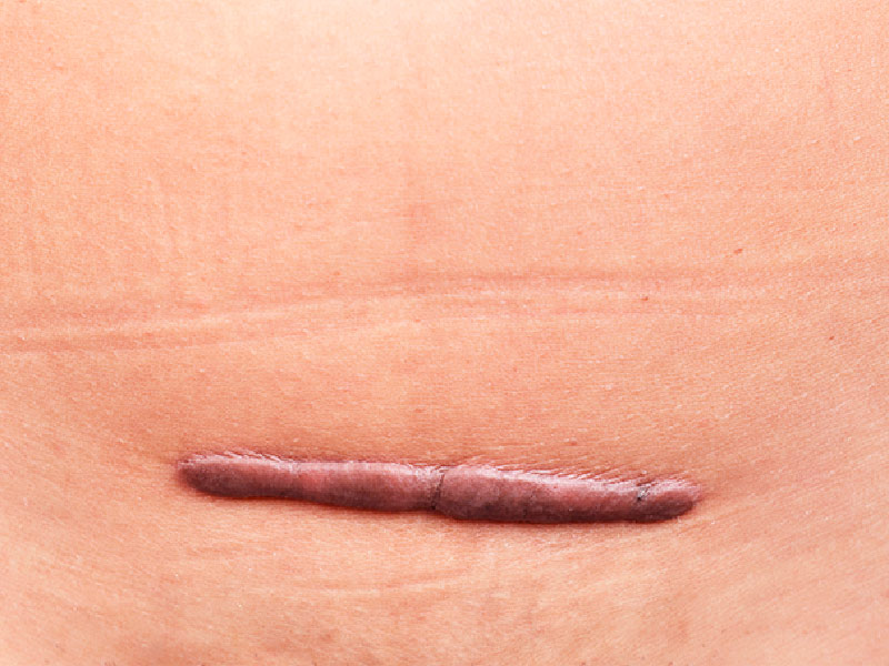 Cicatriz de mamoplastia com queloide