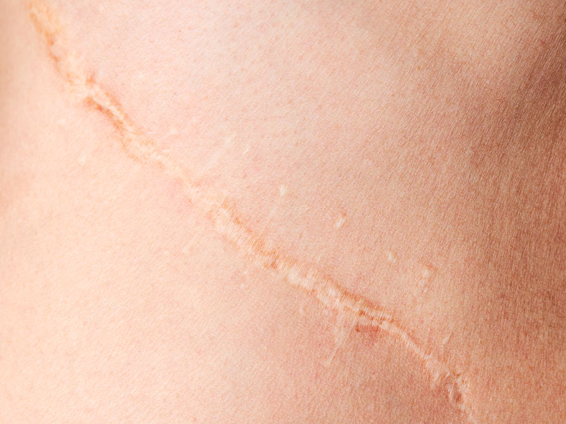 cicatriz hipertrófica na mamoplastia
