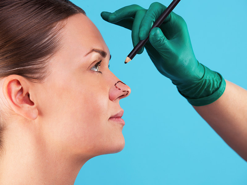 Quando fazer rinoplastia? Na imagem o cirurgião realiza marcações na ponta e nas laterais do nariz da paciente
