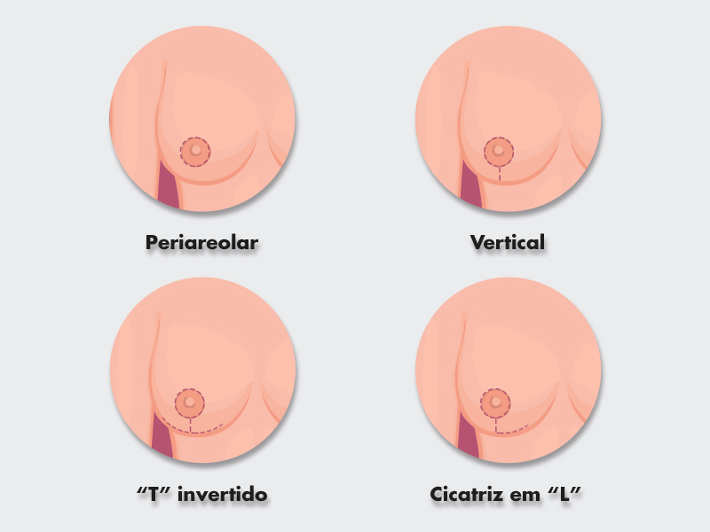 Quais os tipos de cicatriz de Mastopexia? mastopexia cicatriz t invertido