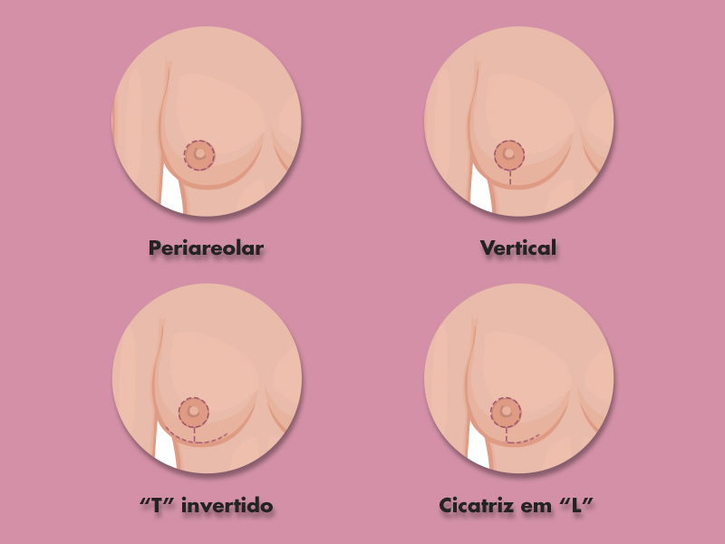 Quais são as cicatrizes da mastopexia? cicatriz mastopexia