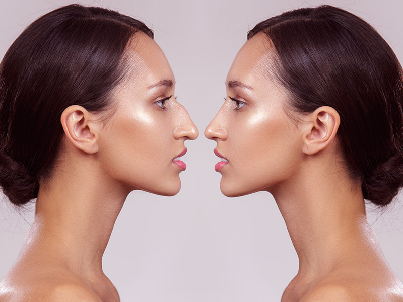Antes e depois da rinoplastia Na imagem uma mesma mulher aparece de frente para si mesma. Do lado esquerdo, o nariz possui um formato torto e com giba (antes da rinoplastia). Do lado direito, a paciente já passou pelo procedimento e está com o nariz fino e reto.