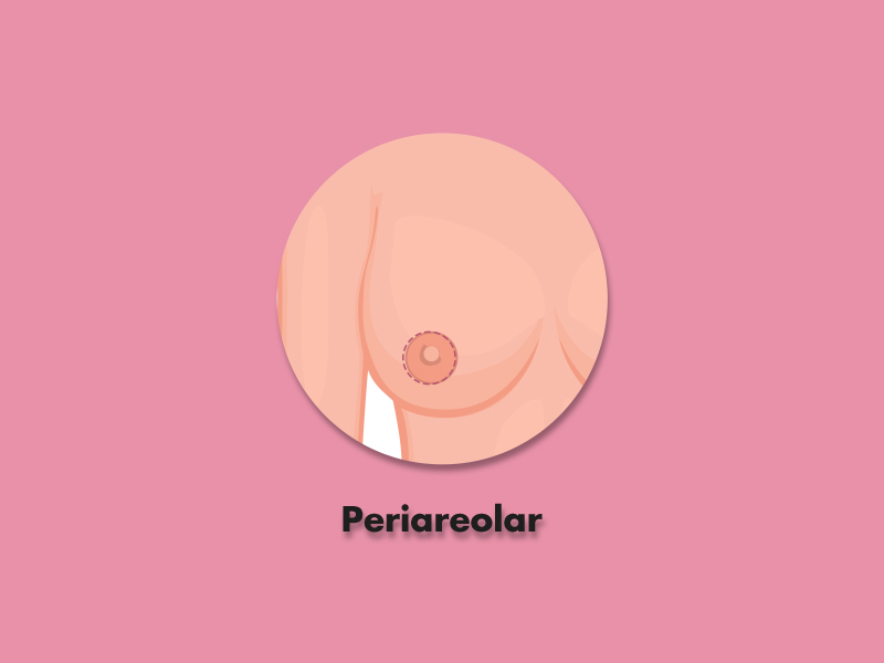 Ilustração da cicatriz periareolar na mastopexia 