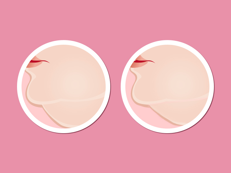 Ilustração mostrando o antes e depois da criofrequência na região da papada