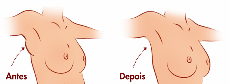 Ilustração de antes e depois da mama acessória axilar