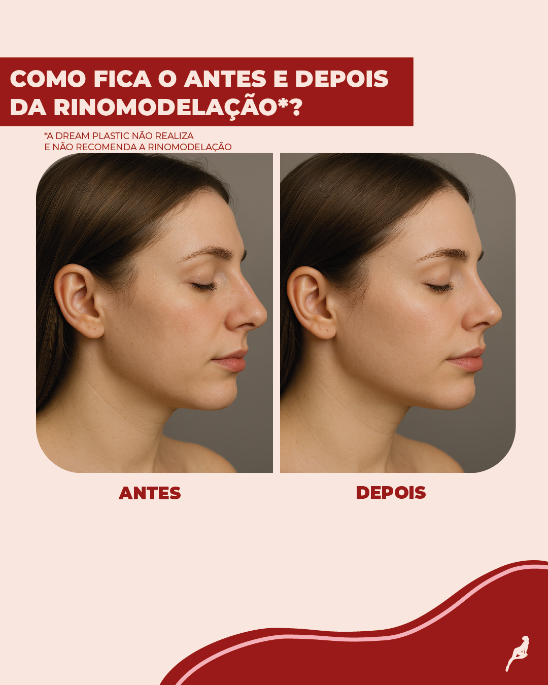Rinomodelação antes e depois: como fica o resultado? Antes e depois da rinomodelação