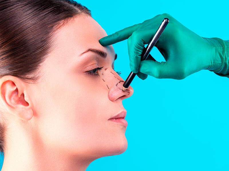 Imagem de uma paciente recebendo marcações no nariz antes de realizar uma rinoplastia secundária.