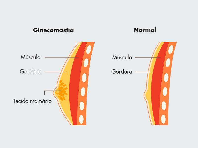 Ilustração que mostra as diferenças entre a estrutura da ginecomastia e da lipomastica no corpo