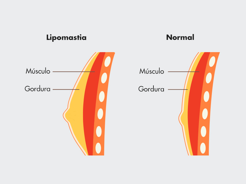 Ilustração que mostra a composição de um peito gordo e um normal