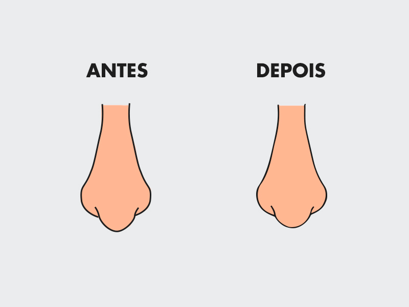 lifting nasal antes depois