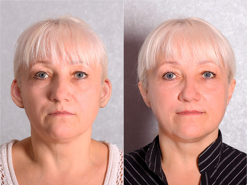 Foto de paciente antes e depois da otoplastia