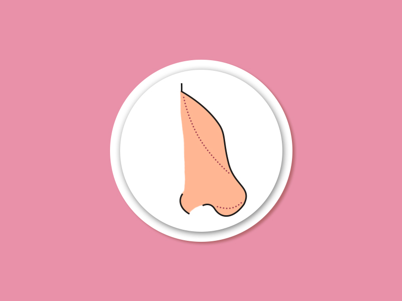 Tem como diminuir giba nasal com Rino? rinoplastia diminuir nariz giba nasal