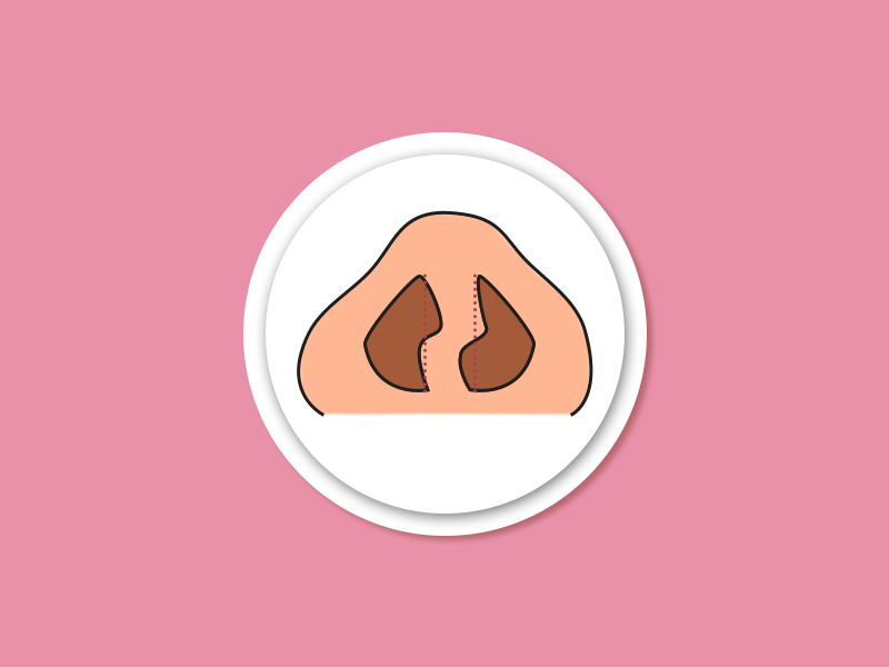 Rinoplastia para columela rinoplastia columela
