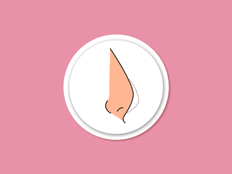 Rinoplastia para nariz achatado rinoplastia nariz asiatico