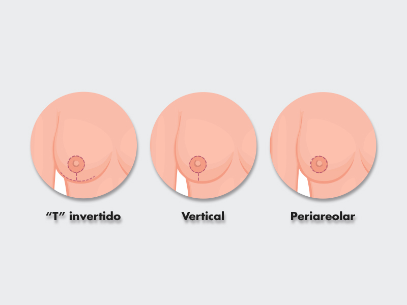 Ilustração da cicatriz de redução de mama