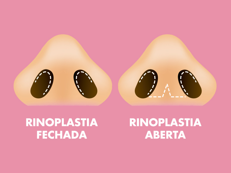 Ilustração de dois narizes, com marcações pontilhadas que remetem aos cortes de uma rinoplastia aberta e fechada